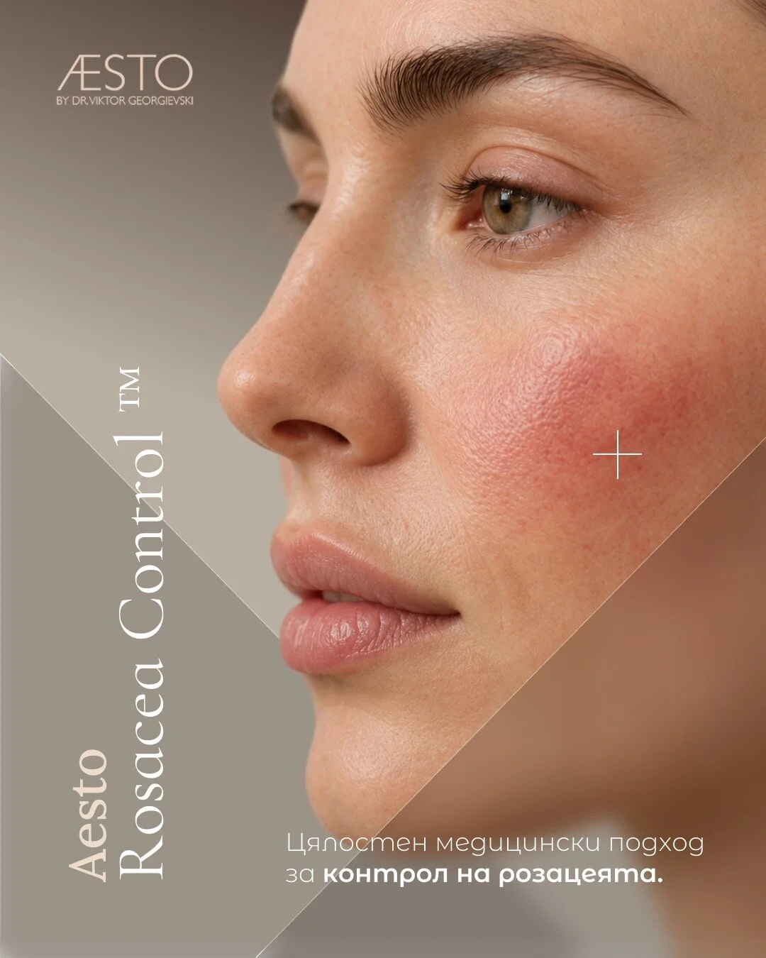 AESTO Rosacea Control™ – цялостен медицински подход за контрол на розацеята